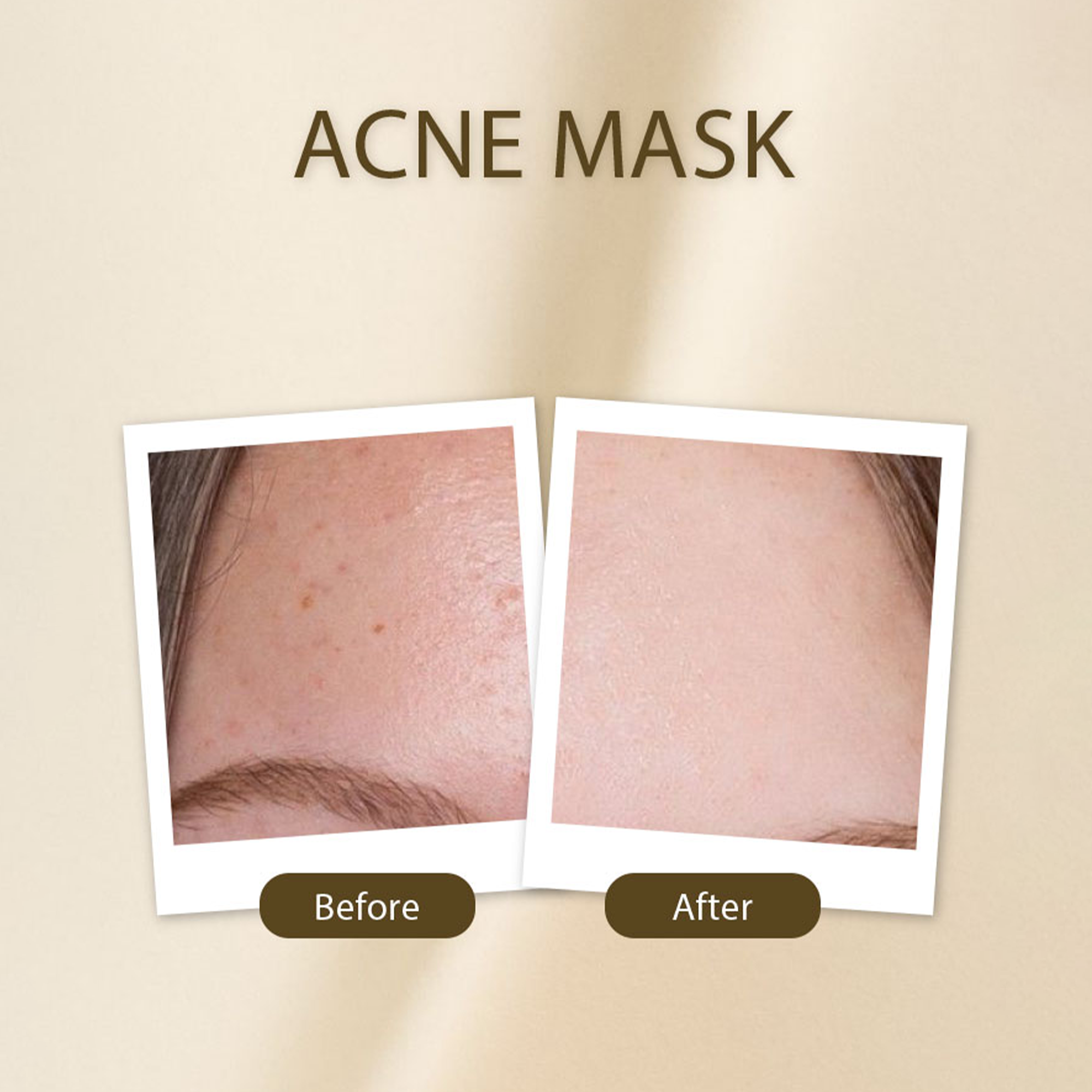 Acne Mask