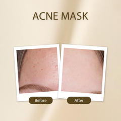 Acne Mask